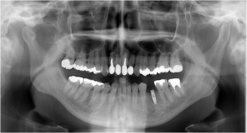 松本7　抜歯後約4ヶ月後埋入直後　ピエゾ骨拡大